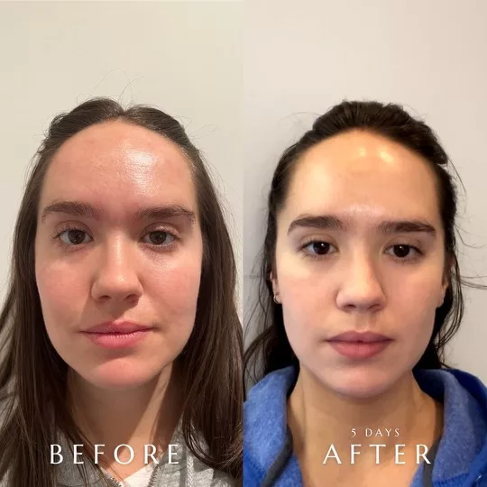 Restylane Image 1