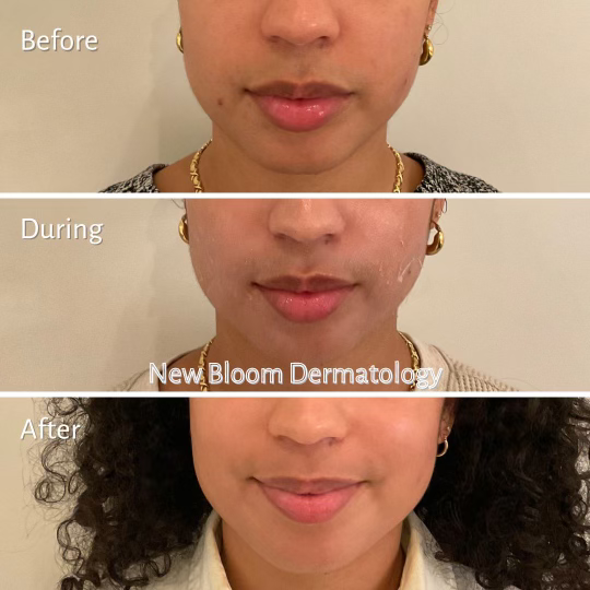 Chemical peel BA 1