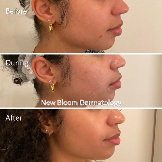 Chemical peel BA 2