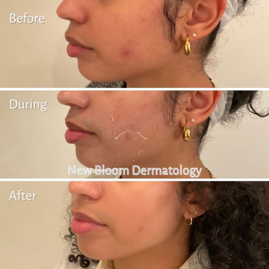 Chemical peel BA 3